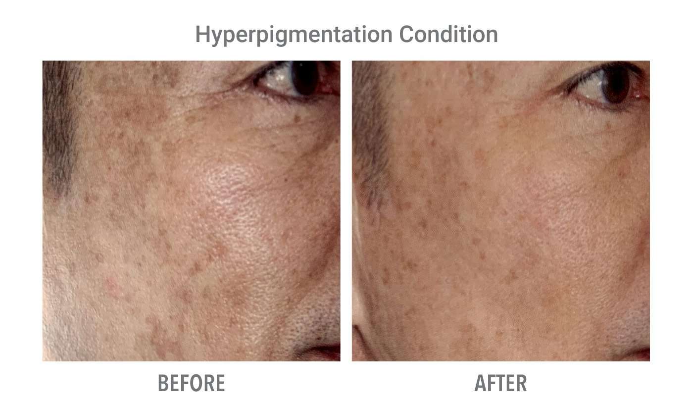SilkPeel Result - Hyperpigmentation Condition