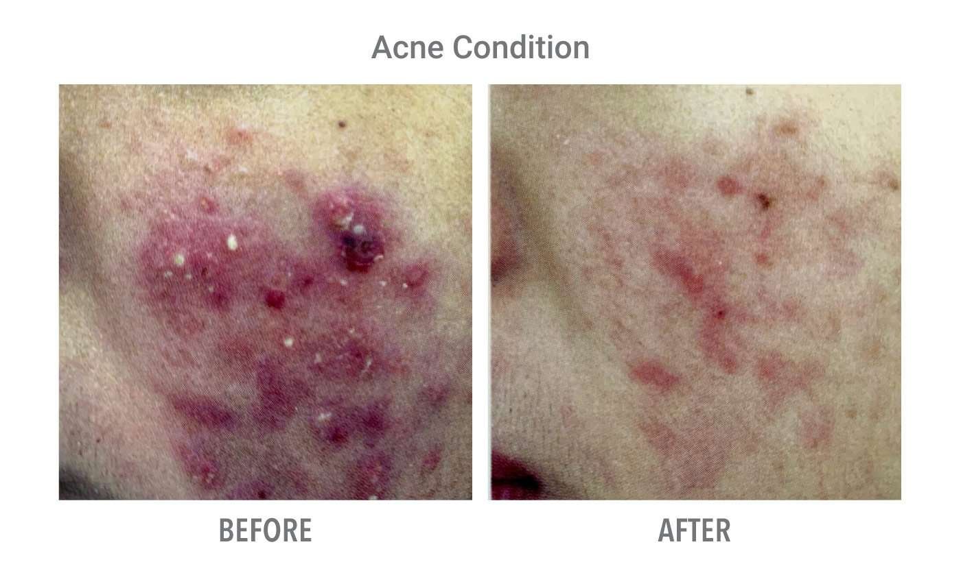 SilkPeel Result - Acne Condition