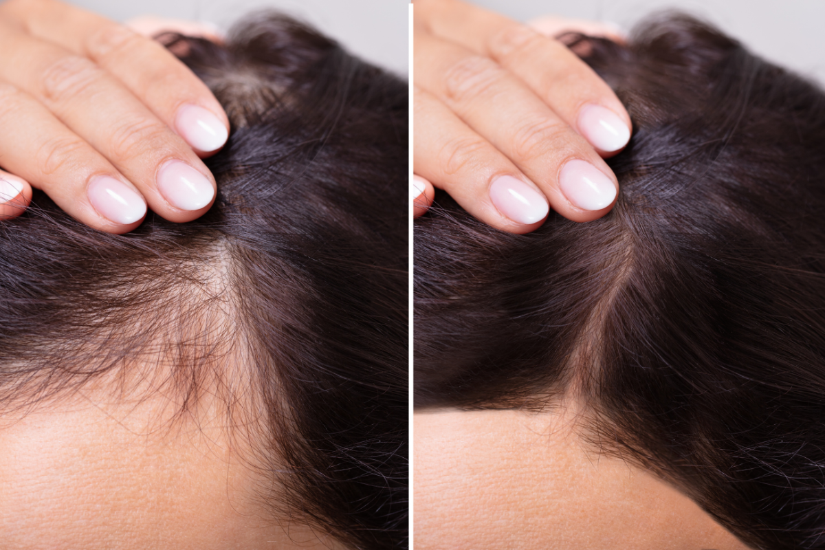 Hair Loss Treatment - Beverly Wilshire Clinic